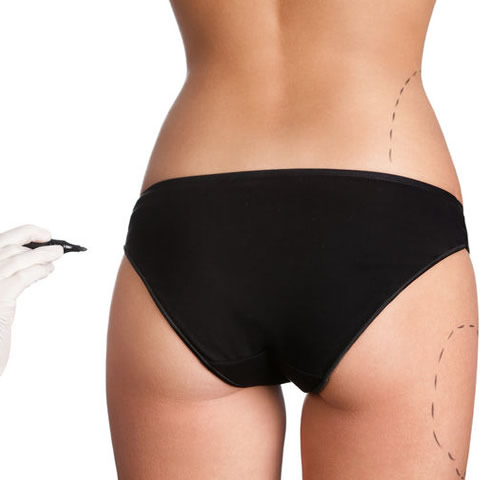 Lipoaspiración